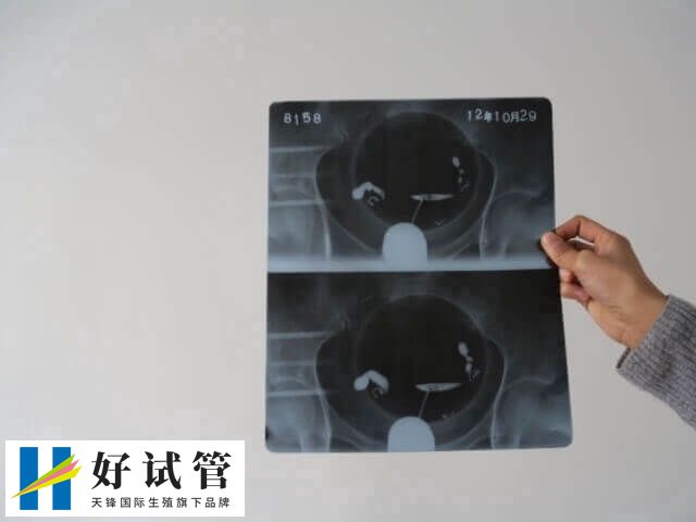 宫颈疾病可能导致出血