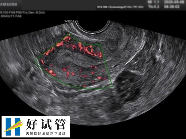 二超检查通常建议在移植后一个月进行