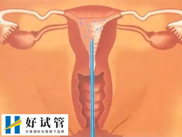 石家庄人工授精手术要一两千元